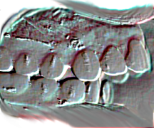 Agenesie canine